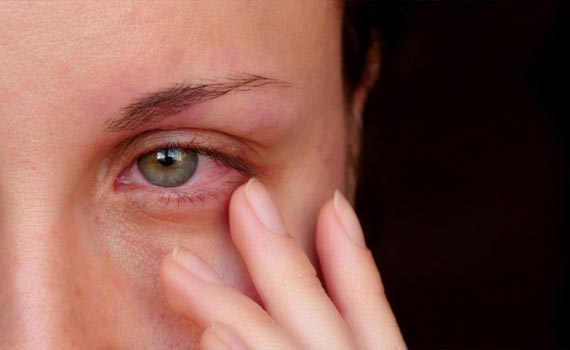 red eyed due to mold exposure